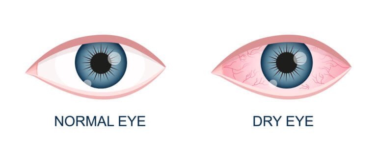 Dry Eye Syndrome