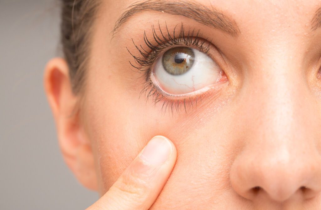 How Omega-3 Helps Relieve Dry Eye Symptoms