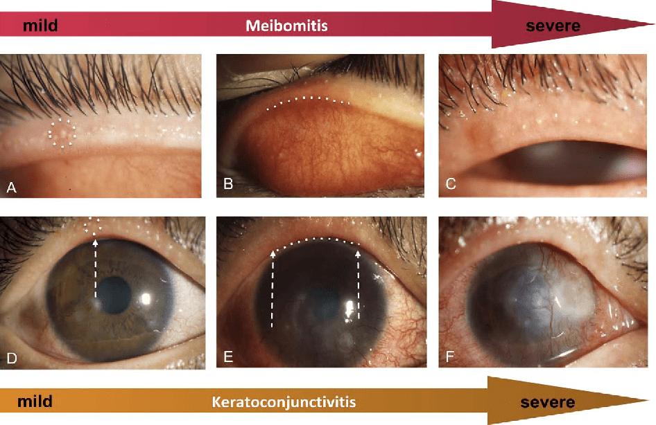 Meibomian Gland Dysfunction