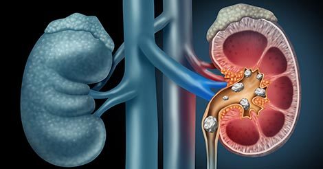 Kidney Stones