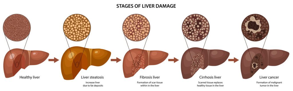 How Liver Cancer Develops