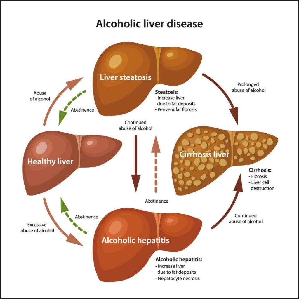 The Role of Alcohol in Liver 