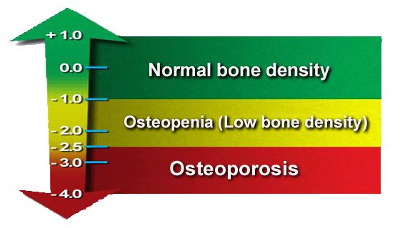 How Bone Density Is Measured