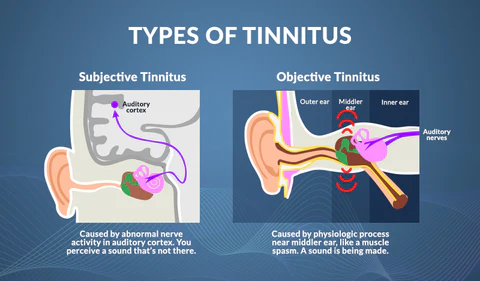 Types of Tinnitus