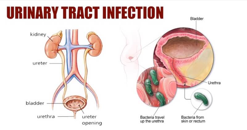 What Urinary Tract Infection (UTI) Means